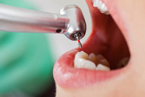 Best Chipped Tooth Repair Near Me  in Newcastle, WY
